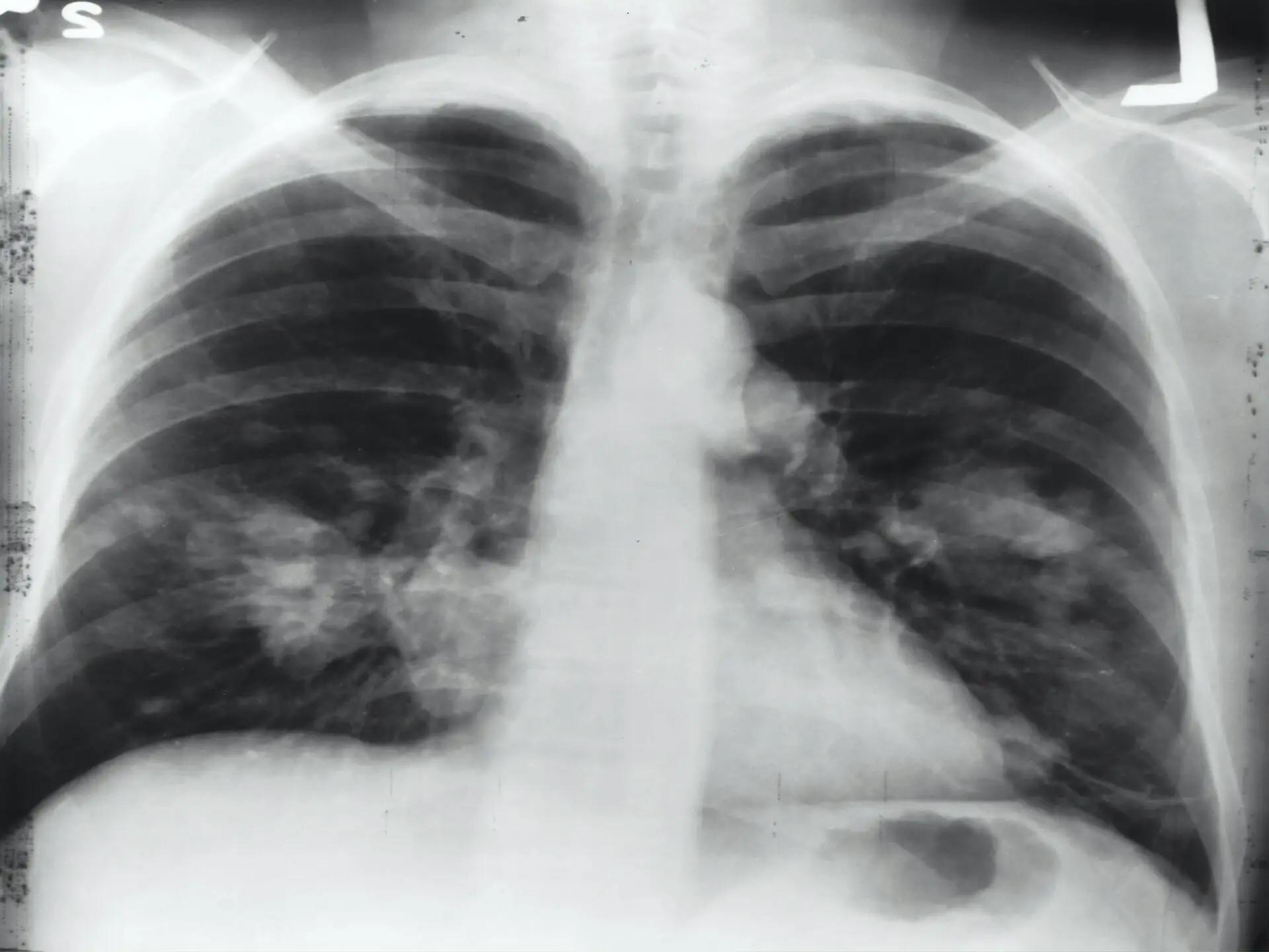 lung xray cancer