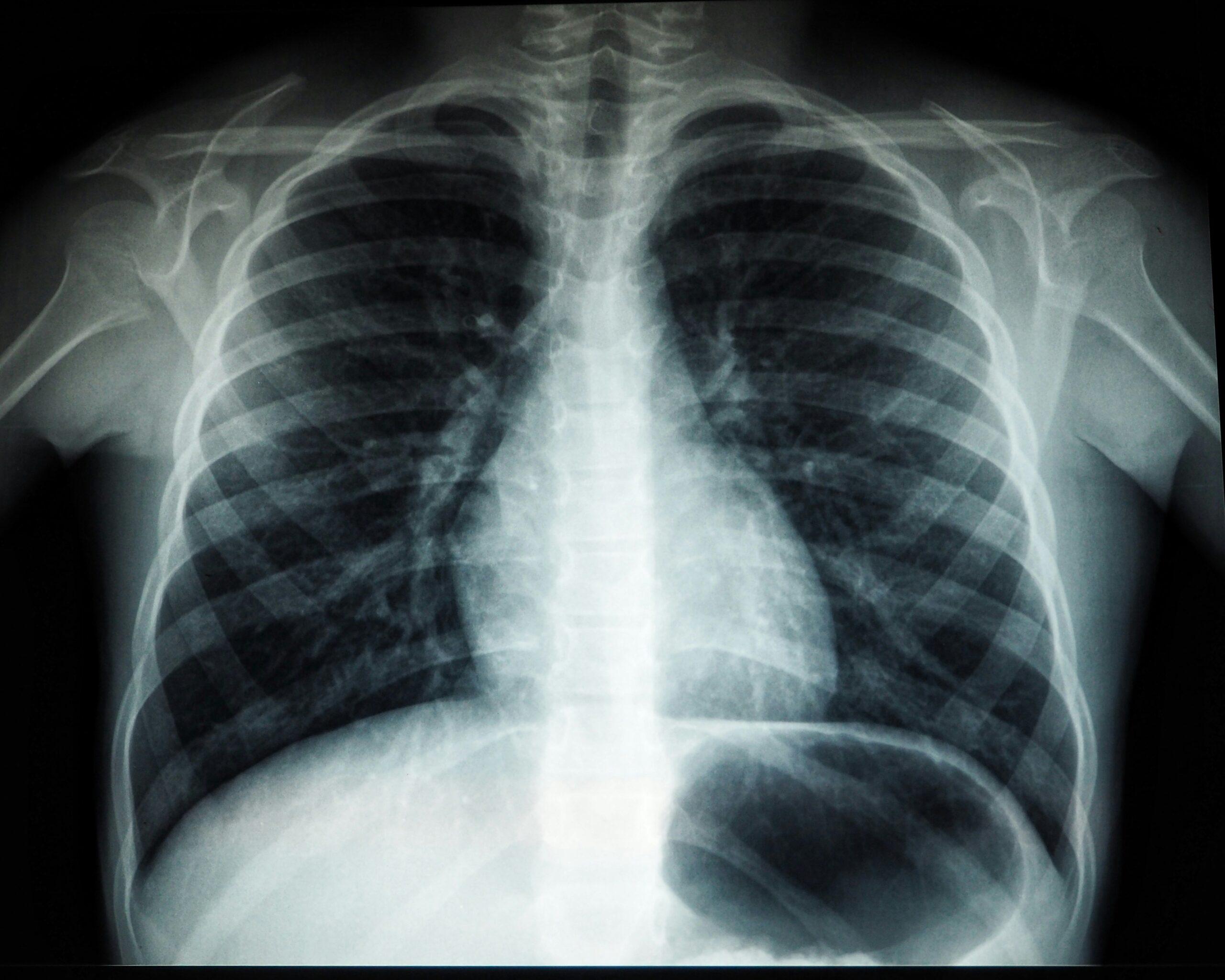 A medical X-ray image showing the chest cavity, with ribs, lungs, and the spine visible in grayscale.